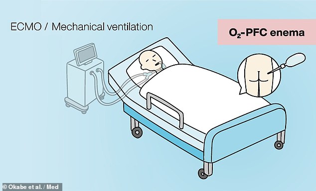 Los investigadores creen que la ventilación mecánica (izquierda) podría reemplazarse con ventilación líquida intestinal (derecha), en la que los pacientes recibirían un enema de perfluoroquímicos oxigenados.