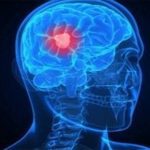 Día mundial del tumor cerebral: conozca las causas, los síntomas y el tratamiento