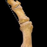 Los investigadores de Cambridge creen que un cambio en el estilo de los zapatos durante el siglo XIV, de una punta redondeada a una punta larga y puntiaguda, provocó un aumento en el hallux valgus