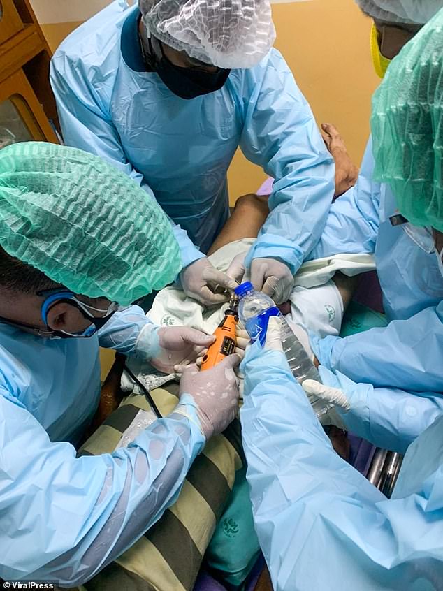 Un tailandés sufrió una desfiguración permanente en el pene después de haberlo atrapado en un candado durante dos semanas.  En la imagen: los médicos pasaron más de 30 minutos usando un cortador eléctrico a través del candado