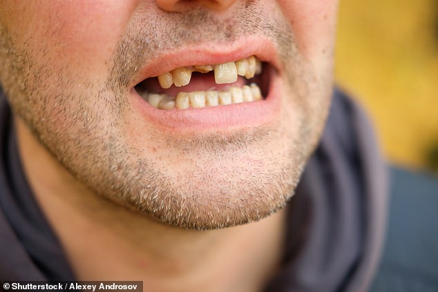 Investigadores de la Universidad de Nueva York descubrieron que la pérdida de dientes es un factor de riesgo tanto para la demencia como para el deterioro cognitivo, y con cada diente perdido, el riesgo aumenta (imagen de archivo)