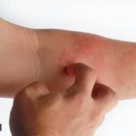 atopic dermatitis (AD), what is atopic dermatitis, causes of atopic dermatitis, symptoms and treatment of atopic dermatitis, skin disease, skin infection, atopic dermatitis medicines, indian express news