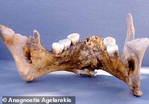 La mandíbula de un guerrero del siglo XIV descubierta en Tracia indica que se había fracturado y luego cableado con hilo de oro mientras sanaba.