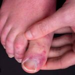 Covid toes, what is Covid toes, what causes Covid toes, new study on Covid toes, are Covid toes painful, Covid toes itchiness, Covid toes and Covid infection, Covid-19 infection side effects, indian express news