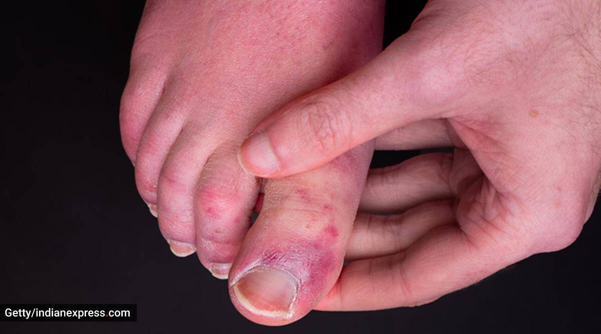 Covid toes, what is Covid toes, what causes Covid toes, new study on Covid toes, are Covid toes painful, Covid toes itchiness, Covid toes and Covid infection, Covid-19 infection side effects, indian express news