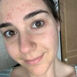La bloguera con sede en Melbourne, Adriana Vanni, de 30 años, le dijo a FEMAIL que luchó contra la mala piel durante años.