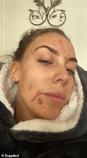 Antes: Louisa Josem, de Melbourne, decidió dejar de usar la píldora anticonceptiva en enero de 2021, pero tres meses después su rostro estaba cubierto de acné hormonal (en la foto
