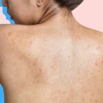 Cómo deshacerse de las cicatrices y marcas de acné, según los dermatólogos