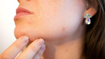 El acné es común pero no normal, dice experto