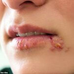Es un problema que afecta a aproximadamente 3.700 millones de personas en todo el mundo, y ahora los científicos han desentrañado la historia, o deberíamos decir 'kiss-tory', del herpes labial.
