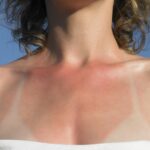 Cómo curar una quemadura de sol lo antes posible, según expertos en el cuidado de la piel