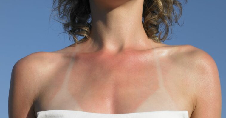 Cómo curar una quemadura de sol lo antes posible, según expertos en el cuidado de la piel