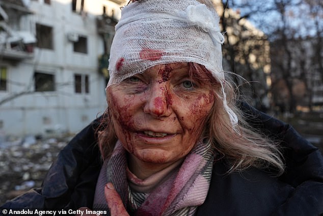 Olena Kurylo, de 52 años, se convirtió en el rostro de la brutalidad de Vladimir Putin cuando los fotógrafos enviaron imágenes desgarradoras de su rostro vendado alrededor del mundo.