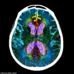Un fármaco experimental para la enfermedad de Alzheimer, llamado lecanemab, ha disminuido significativamente el deterioro cognitivo y funcional en un 27 % en un gran ensayo con pacientes