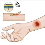 Los científicos desarrollaron un vendaje inteligente que puede ayudar a acelerar la cicatrización de heridas al monitorear la lesión y tratarla al mismo tiempo.