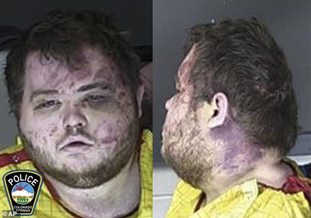 En la foto: el rostro de Anderson Lee Aldrich después de que lo golpearon y sometieron cuando abrieron fuego dentro del club nocturno gay Club Q en Colorado, matando a cinco e hiriendo a 15