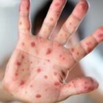 Casos Mpox en Panamá suman 78 hasta el momento