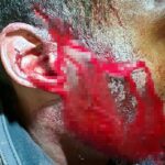 Imágenes impactantes muestran heridas horribles en la cara de un miembro del personal de un club nocturno después de que fueron atacados por un grupo en una carrera de despedida de soltero en Cheltenham.  La víctima necesitó 16 puntos de sutura en la cara y la cabeza.