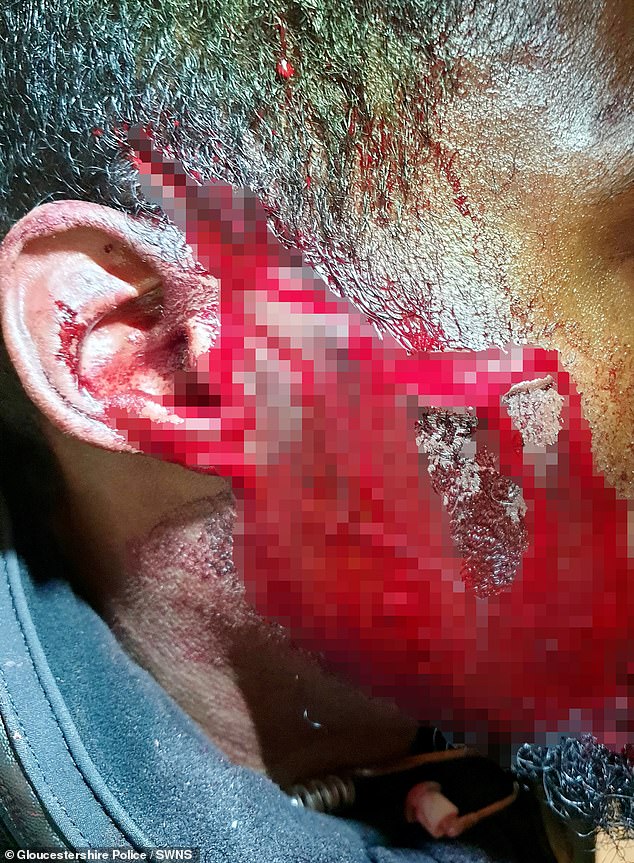 Imágenes impactantes muestran heridas horribles en la cara de un miembro del personal de un club nocturno después de que fueron atacados por un grupo en una carrera de despedida de soltero en Cheltenham.  La víctima necesitó 16 puntos de sutura en la cara y la cabeza.