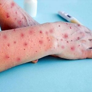 Nuevos casos de Mpox reportados en Panamá, totalizando 63 a la fecha
