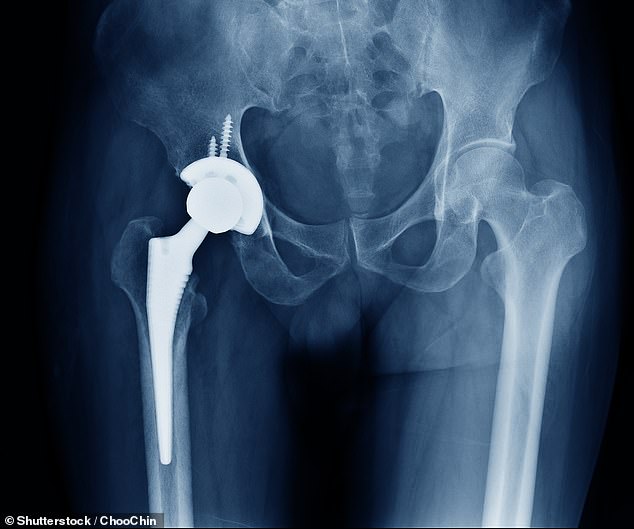 Las complicaciones de la cirugía de reemplazo de cadera fueron atribuidas a las muertes de George Pell y Renee Geyer (en la foto, stock)