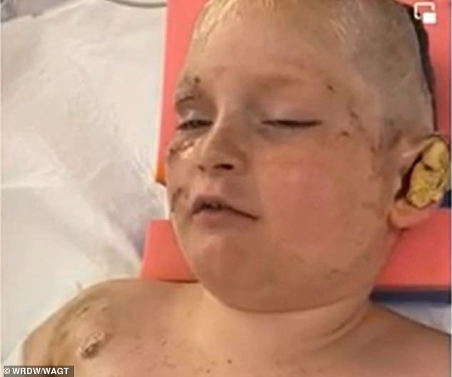 Justin Gilstrap, de 11 años, de Appling, Georgia, se sometió a varias cirugías después de que una manada de pitbulls lo atacara el viernes.