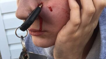 Renée Lariviere, de 24 años, se quedó con las llaves de su auto clavadas en su cara después de que un amigo se las arrojó en un 'accidente extraño'