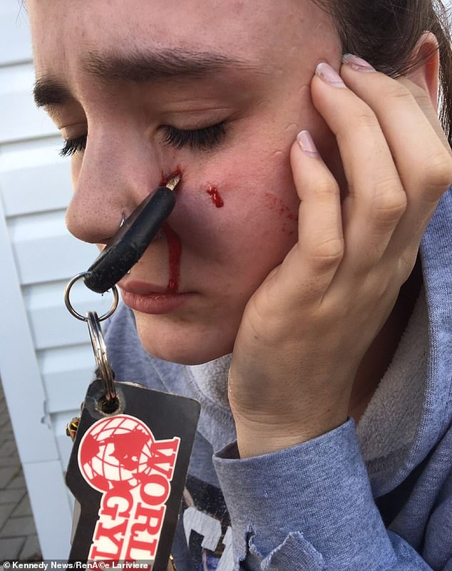 Renée Lariviere, de 24 años, se quedó con las llaves de su auto clavadas en su cara después de que un amigo se las arrojó en un 'accidente extraño'