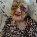 Nancy, de 89 años, tenía moretones inexplicables en la cara mientras estaba en un hogar de ancianos de Glasgow.