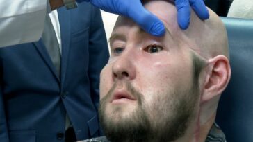 Los cirujanos realizan por primera vez en el mundo un trasplante de un ojo humano completo
