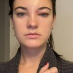 En el video inicial, Brooke Hyland, de 25 años, dijo que se despertó con un ojo extremadamente hinchado después de apretarse un grano que estaba cerca de su ceja.