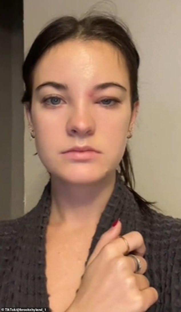 En el video inicial, Brooke Hyland, de 25 años, dijo que se despertó con un ojo extremadamente hinchado después de apretarse un grano que estaba cerca de su ceja.