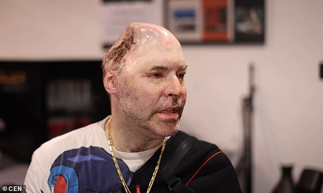 Niko Brenner (en la foto), un rapero que perdió casi la mitad de su cráneo tras una explosión en un laboratorio de drogas mientras preparaba una bebida llamada 'Nazi Gold', se enfrenta a cinco años de cárcel en Alemania.