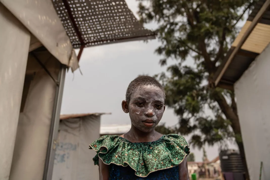 Cabo Verde refuerza vigilancia en las entradas del país ante brote de Mpox - teleSUR
