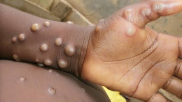 Uganda informa de los dos primeros casos de mpox — Mundo — The Guardian Nigeria News – Nigeria y noticias del mundo
