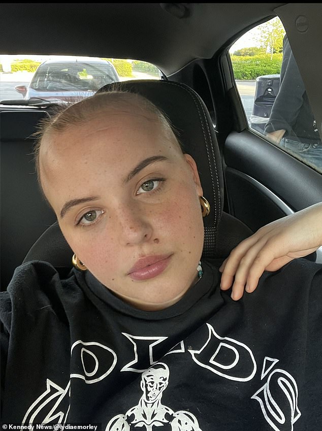 Lydia Morley (en la foto) fue diagnosticada con alopecia areata en enero de este año.