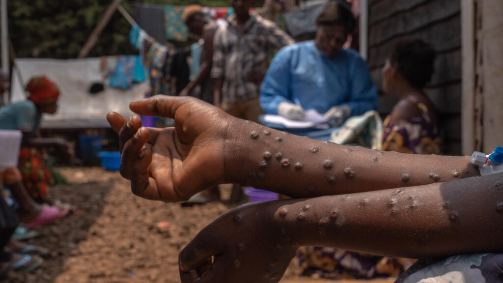 La República Democrática del Congo recibirá sus primeras 100.000 dosis de la vacuna mpox
