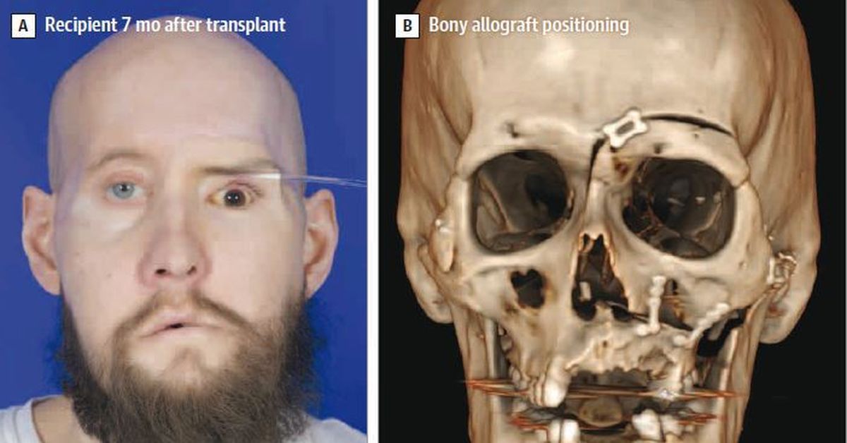 Los médicos elogian el primer trasplante de ojo del mundo tras un resultado histórico
