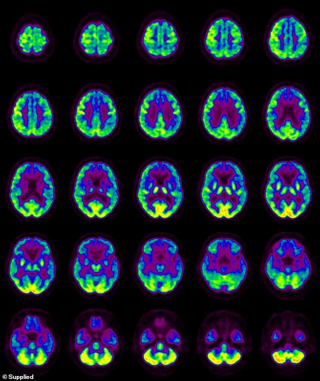 Una tomografía por emisión de positrones (PET) del cerebro humano