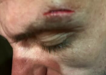 Primer plano de la frente de un hombre que muestra un corte.