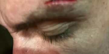 Primer plano de la frente de un hombre que muestra un corte.