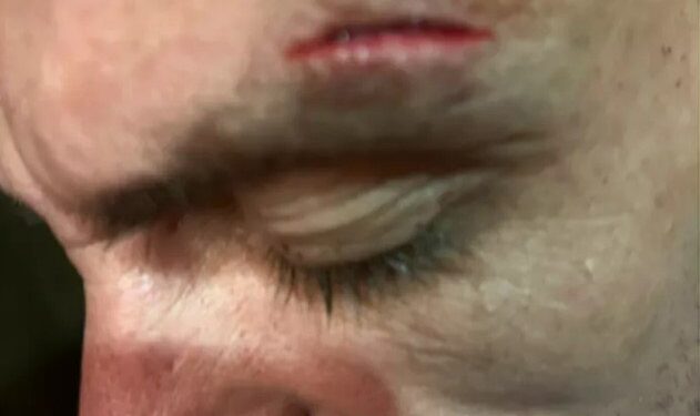 Primer plano de la frente de un hombre que muestra un corte.