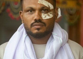 El único sobreviviente de un accidente aéreo de Air India con vendas en su rostro.