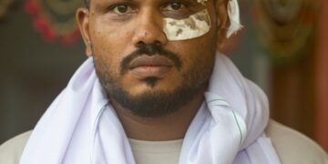 El único sobreviviente de un accidente aéreo de Air India con vendas en su rostro.