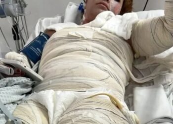 Gabriele Cristine Barreto en una cama de hospital con vendas de quemaduras.