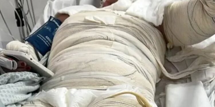 Gabriele Cristine Barreto en una cama de hospital con vendas de quemaduras.