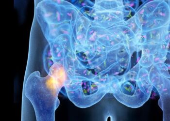 Un conductor pasado por alto de la osteoporosis