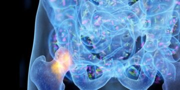 Un conductor pasado por alto de la osteoporosis