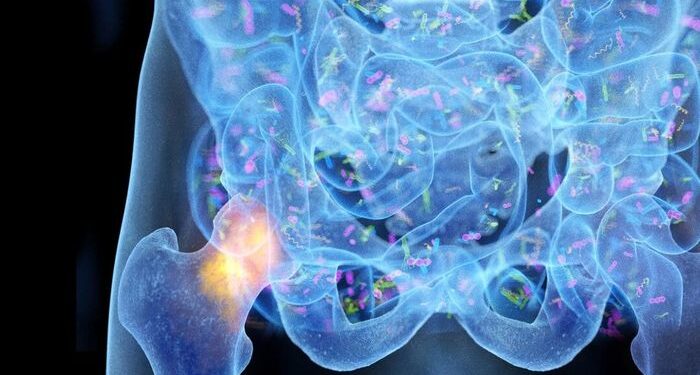 Un conductor pasado por alto de la osteoporosis