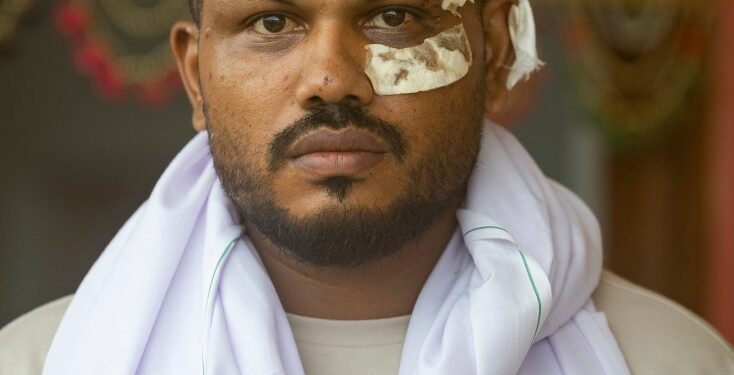 El único sobreviviente de un accidente aéreo de Air India con vendas en su rostro.